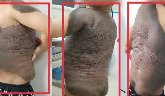 6 lần đại phẫu cắt bỏ khối u 'mai rùa' nặng trĩu trên lưng bé trai 7 tuổi