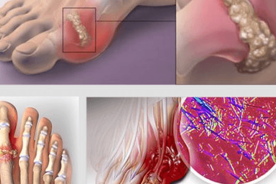 Bị bệnh gout có nên ăn cá?