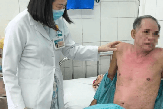 Dị ứng thuốc nhỏ mắt, người đàn ông bị hoại tử thượng bì nhiễm độc nguy kịch