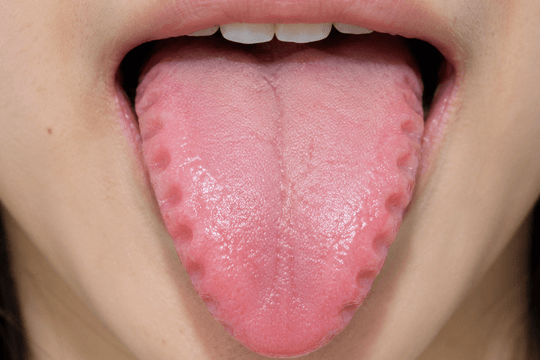 Lưỡi hằn dấu răng cảnh báo điều gì theo y học cổ truyền?