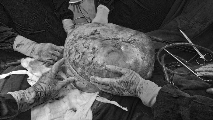 Phẫu thuật lấy thành công khối u nặng 30kg trong cơ thể người