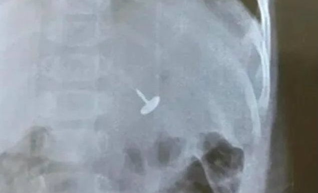 Gắp bỏ chiếc đinh vít sắc nhọn trong dạ dày bé trai 11 tháng tuổi