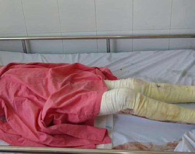 Trượt chân vào bồn chứa nước mắm, người đàn ông bị bỏng nặng