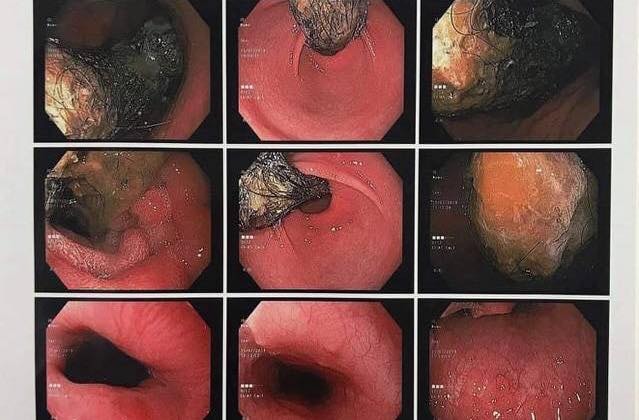 Bé gái 9 tuổi ở Thái Bình mắc chứng nghiện nhổ tóc để... ăn