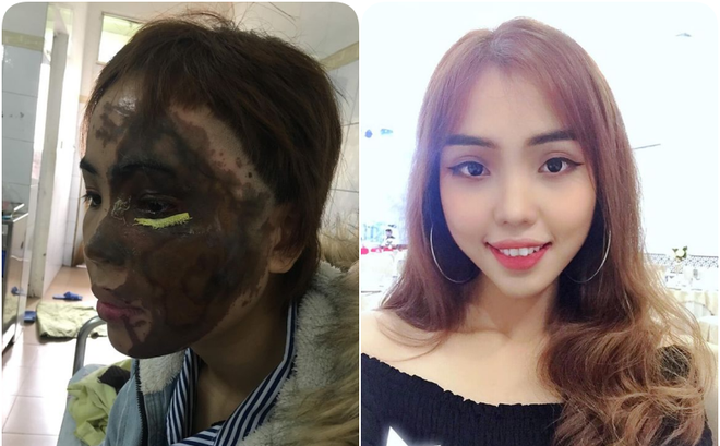 Cựu thiếu úy công tạt axit vào mặt vợ sắp cưới chuẩn bị hầu tòa