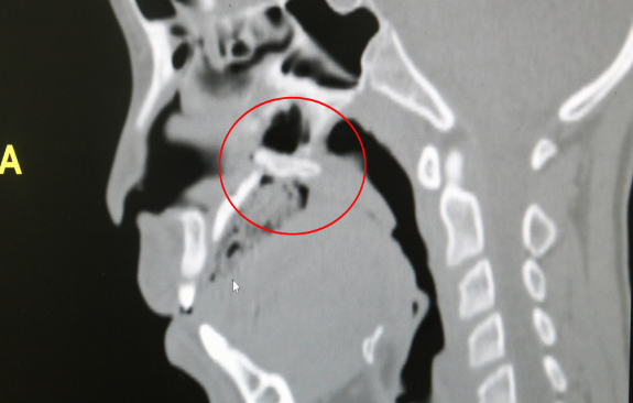 Bé trai 10 tuổi thủng vòm họng do ngã xe đạp