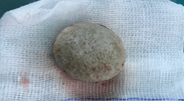 Phẫu thuật lấy viên sỏi hơn 3cm trong bàng quang bé trai 13 tuổi