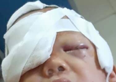 Cháu bé 20 tháng tuổi bị chó nhà tấn công rách nát vùng đầu mặt