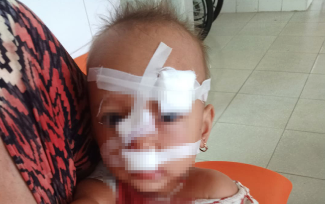 Xót xa bé gái 2 tuổi nhập viện, khâu 12 mũi trên mặt vì bố mẹ cãi nhau