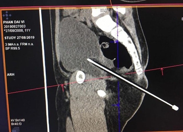 Bạn để bút chì trên ghế, bé trai 11 tuổi bị đâm thấu bụng