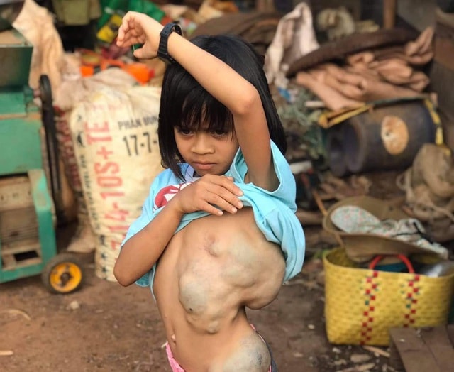 Giải cứu bé gái 8 tuổi mang khối bướu khổng lồ chiếm 1/3 trọng lượng cơ thể