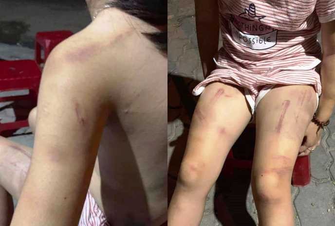 Bé gái 6 tuổi bị cụ nội dùng gậy đánh bầm tím khắp cơ thể