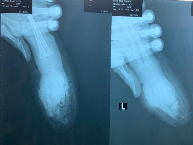 Người lớn sơ sẩy vài giây, bé trai 1 tuổi bị đứt lìa bàn tay