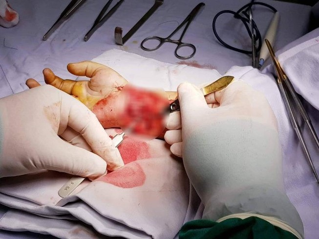 Ngã trúng viên gạch vỡ, bé trai 6 tuổi đứt gần lìa bàn tay