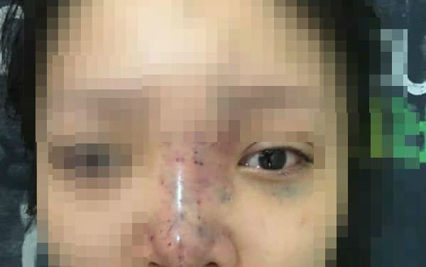 Hai phụ nữ mù mắt sau khi tiêm chất làm đầy