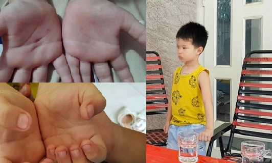 Đóng cửa trường mầm non có giáo viên bị tố đâm vật nhọn vào tay trẻ