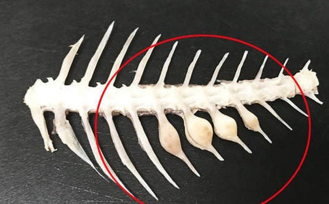 Người phụ nữ suýt mất mạng do xương cá nhọn đâm vào ổ bụng