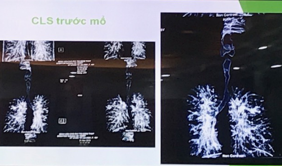 Cứu sống cô gái 18 tuổi bị sẹo khí quản bít đường thở do lao hiếm gặp