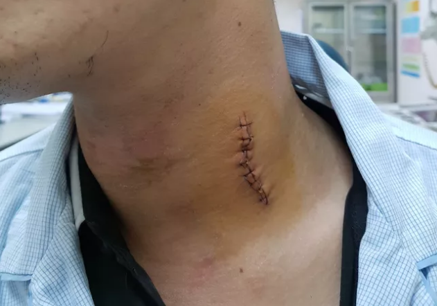 Phẫu thuật lấy mảnh kim loại găm vào vùng cổ thợ sửa ô tô