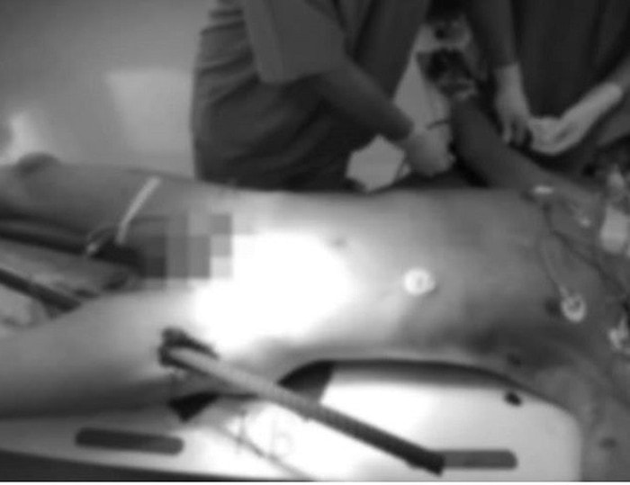 Cứu sống nam thanh niên bị 2 cọc sắt đâm xuyên người