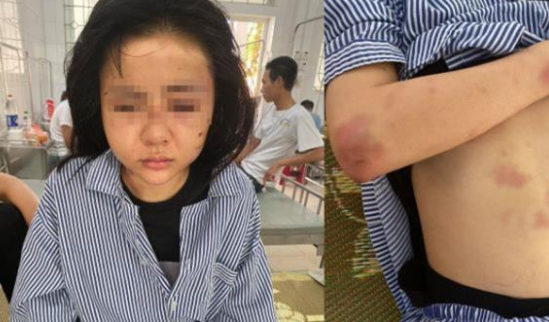 Kết quả giám định của cô gái bị thanh niêm xăm trổ hành hung suốt nhiều giờ ở Yên Bái