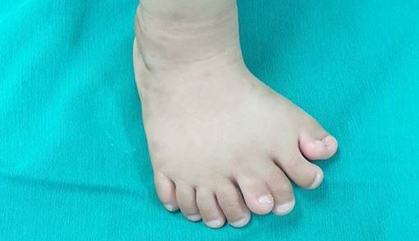 Phẫu thuật thành công cho bé trai 11 tháng tuổi có 9 ngón chân trên một bàn