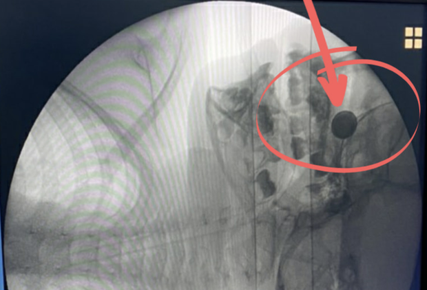 Cháu bé 4 tuổi suýt mất mạng vì lấy cục pin nhét vào mũi