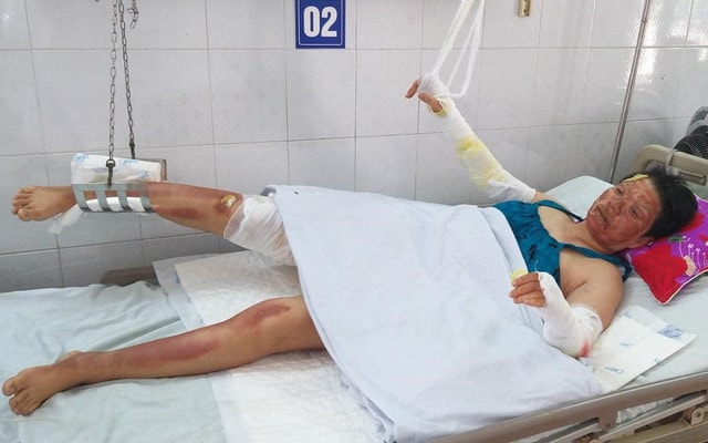 Chồng mất, 3 mẹ con bị bỏng nặng sau vụ cháy điều hòa đang rất cần sự giúp đỡ