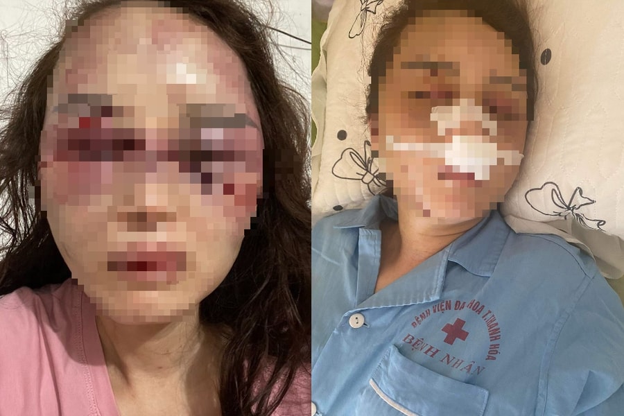 Cán bộ QLTT đánh bạn gái dã man vì ghen tuông đối diện tội danh nào?