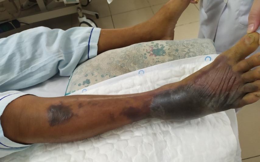 Hoại tử chân, nhiễm khuẩn huyết do vi khuẩn Vibrio vulnificus