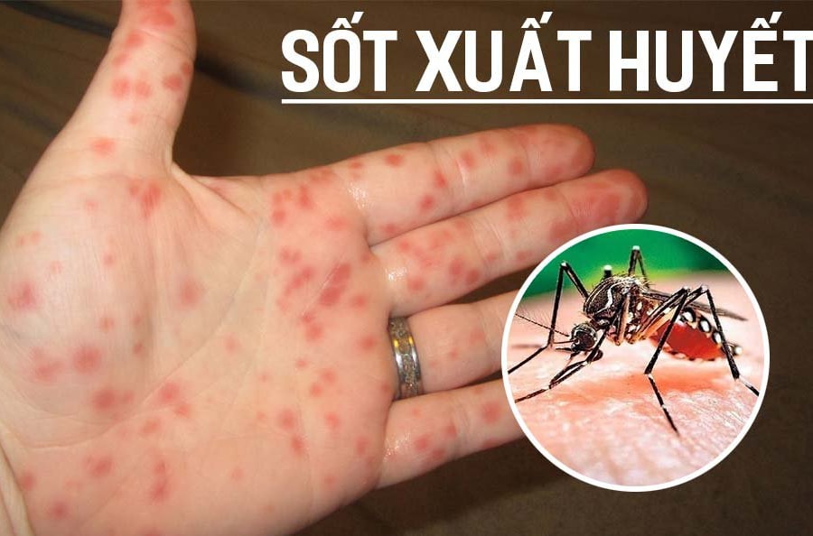 Dịch sốt xuất huyết ở Hà Nội diễn biến phức tạp, chuyên gia đưa ra khuyến cáo