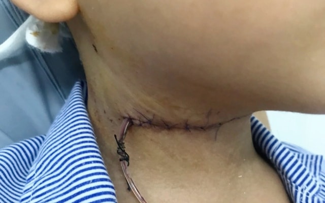 Mẩu gỗ dài 4cm bị 'bỏ quên' trong cổ bé 5 tuổi