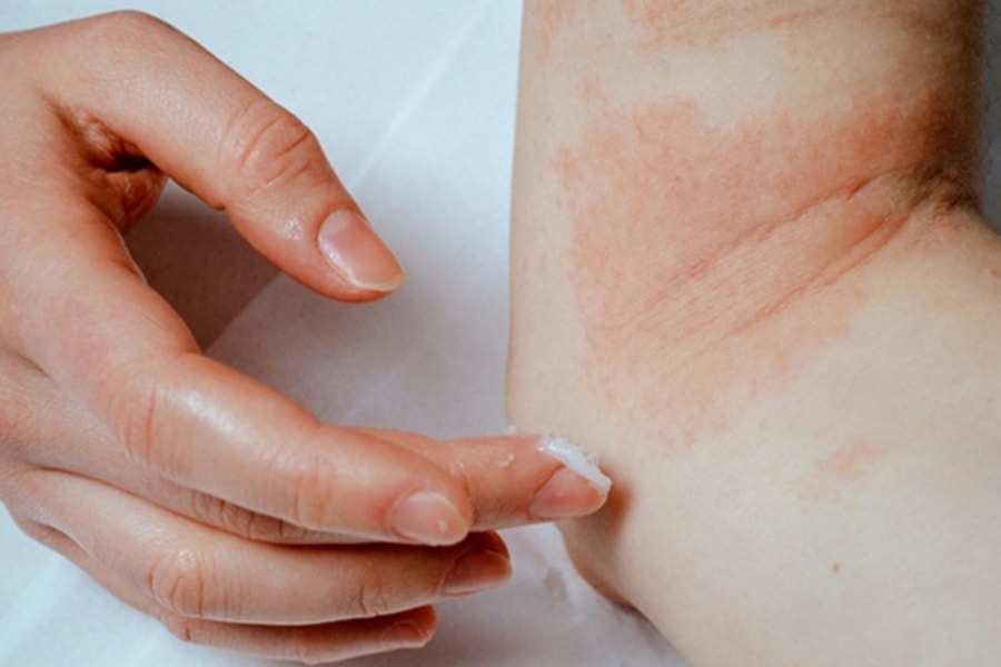 6 bệnh về da thường gặp sau bão lũ và cách điều trị