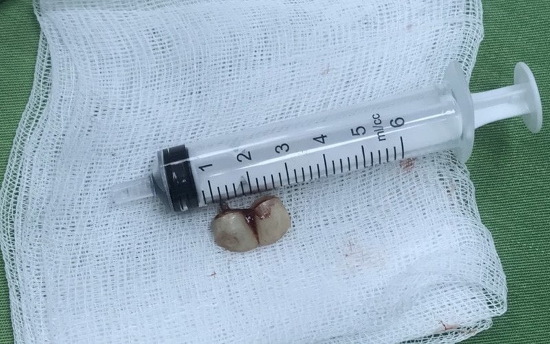 Quảng Ninh: Người phụ nữ nhập viện vì 2 chiếc răng giả trong phế quản