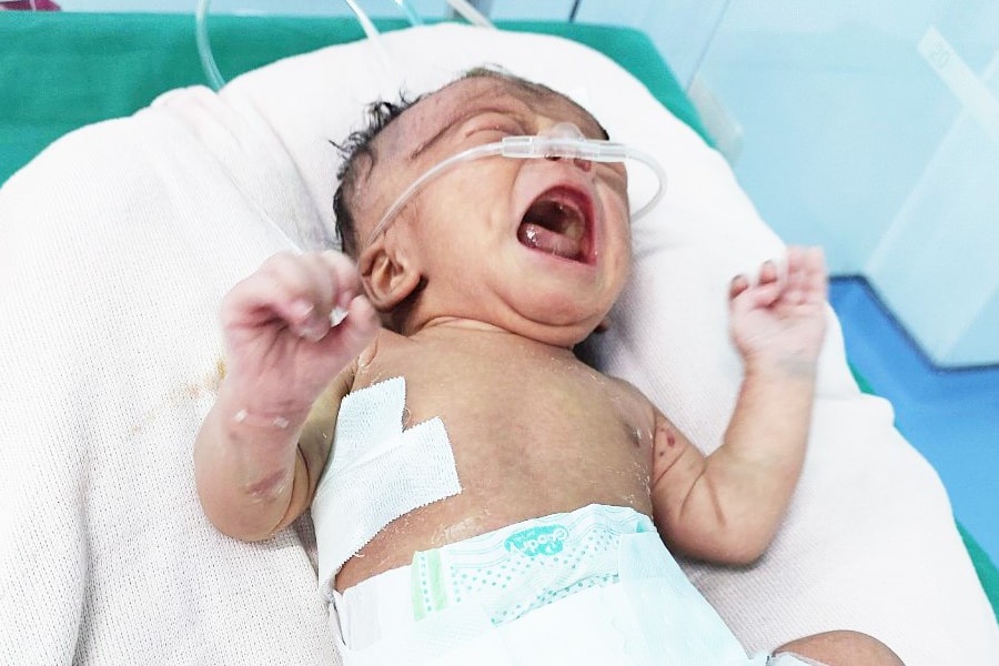 Kon Tum: Cứu sống thành công bé gái 3 ngày tuổi bị teo thực quản bẩm sinh