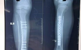 Căn bệnh hiếm "loạn sản xơ xương" khiến 2 chân bé 10 tuổi không bằng nhau