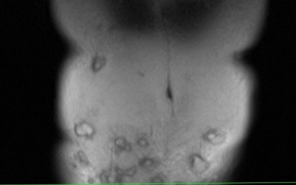 Người phụ nữ bị hoại tử vùng bụng sau khi tiêm tan mỡ bụng