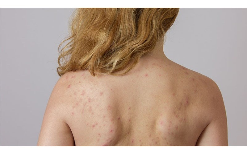 Những điều cần ghi nhớ để trị mụn lưng hiệu quả tại nhà