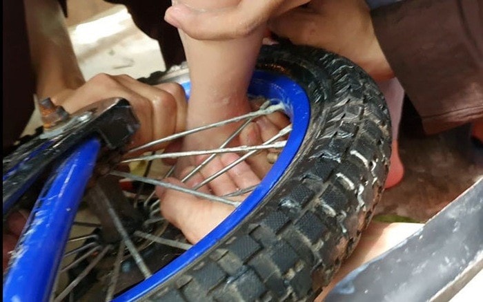 Bé gái 2 tuổi bị dập nát phần mềm gót chân do kẹt vào nan hoa xe đạp