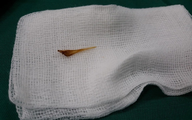 Cấp cứu thành công bệnh nhân thủng ruột do nuốt xương cá