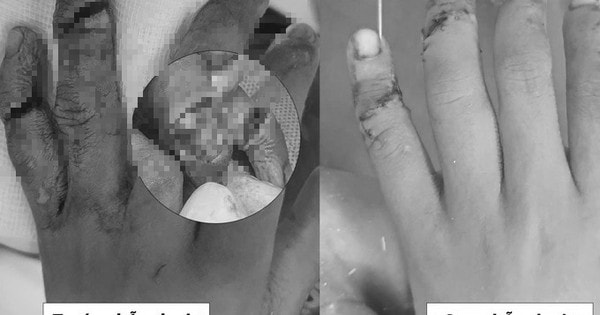 BV Nhi Trung ương phẫu thuật nối 2 ngón tay gần đứt rời cho bé trai 7 tuổi