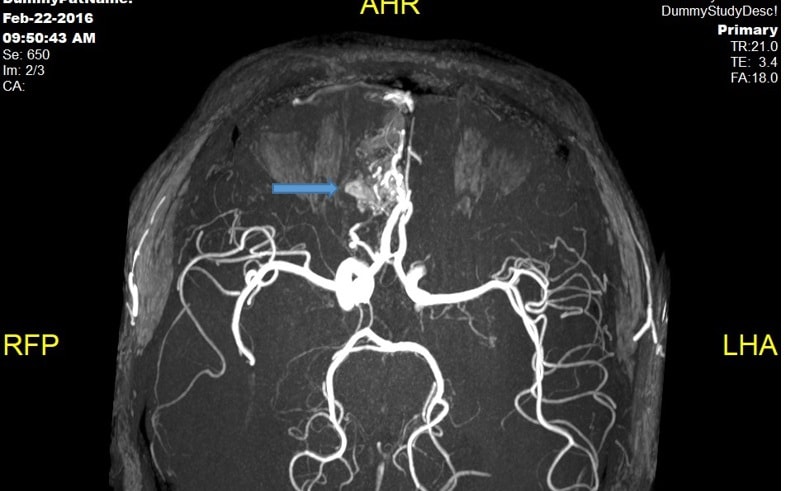 Đi khám, trẻ 14 tuổi mới biết mắc bệnh lạ