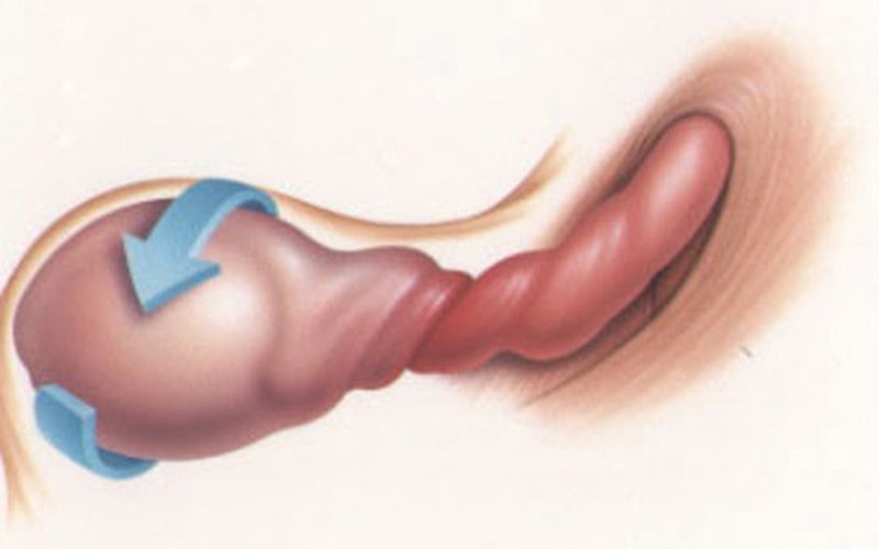 Nam thanh niên cấp cứu vì bị xoắn tinh hoàn