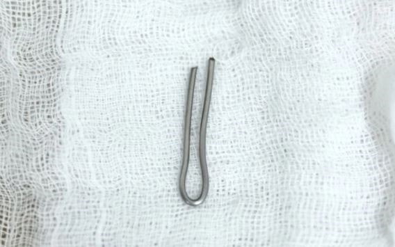 Gắp mảnh kim khí trong đường tiêu hóa bé trai 4 tuổi