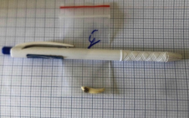 Tá hóa khi biết có răng mọc trong hốc mũi sau khi đi khám 