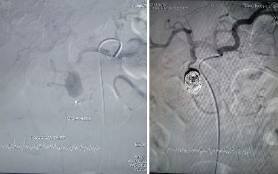 Cứu sống bệnh nhân vỡ giả phình động mạch vị tá tràng hiếm gặp