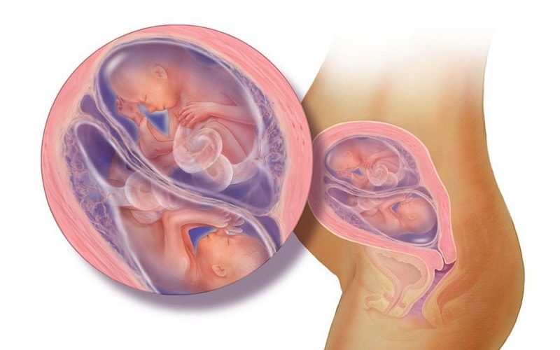 Các biến chứng nguy hiểm khi mang đa thai