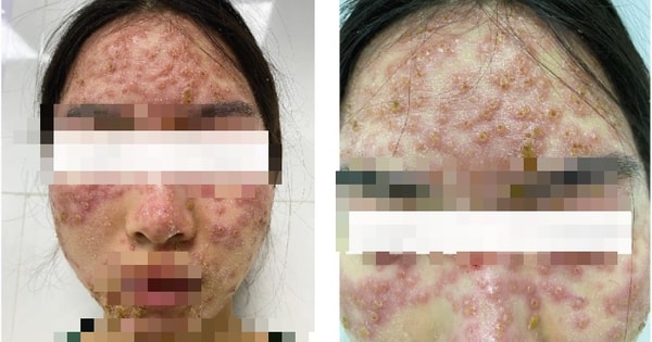 Đắp mặt nạ detox, người phụ nữ bị bội nhiễm da Herpes simplex