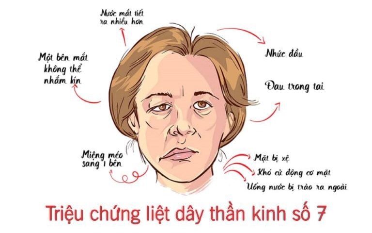 Liệt dây thần kinh số 7 ngoại biên và cách điều trị
