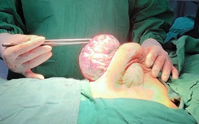 Bóc tách khối u vú 'khổng lồ' cho thiếu nữ 15 tuổi